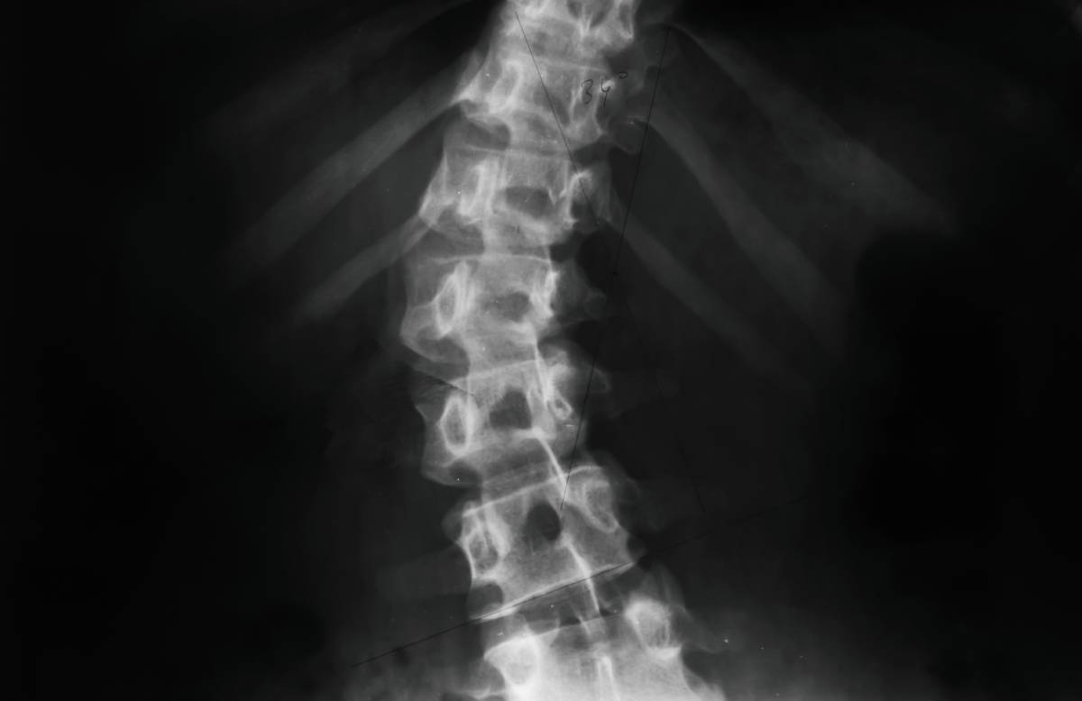 Spinal Abnormalities in Neuraxial Anesthesia