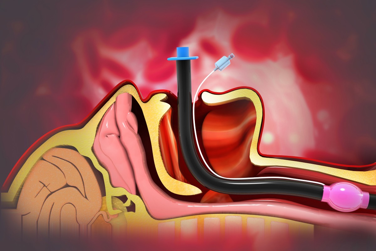 Vocal Cord Complications After Intubation